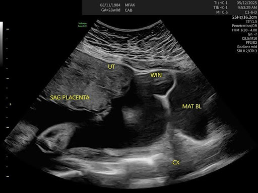 Uterine Window Defect