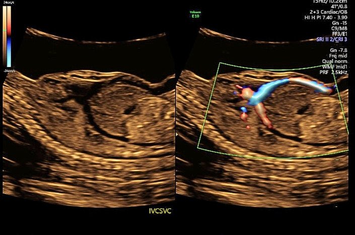 Absent Ductus Venosus