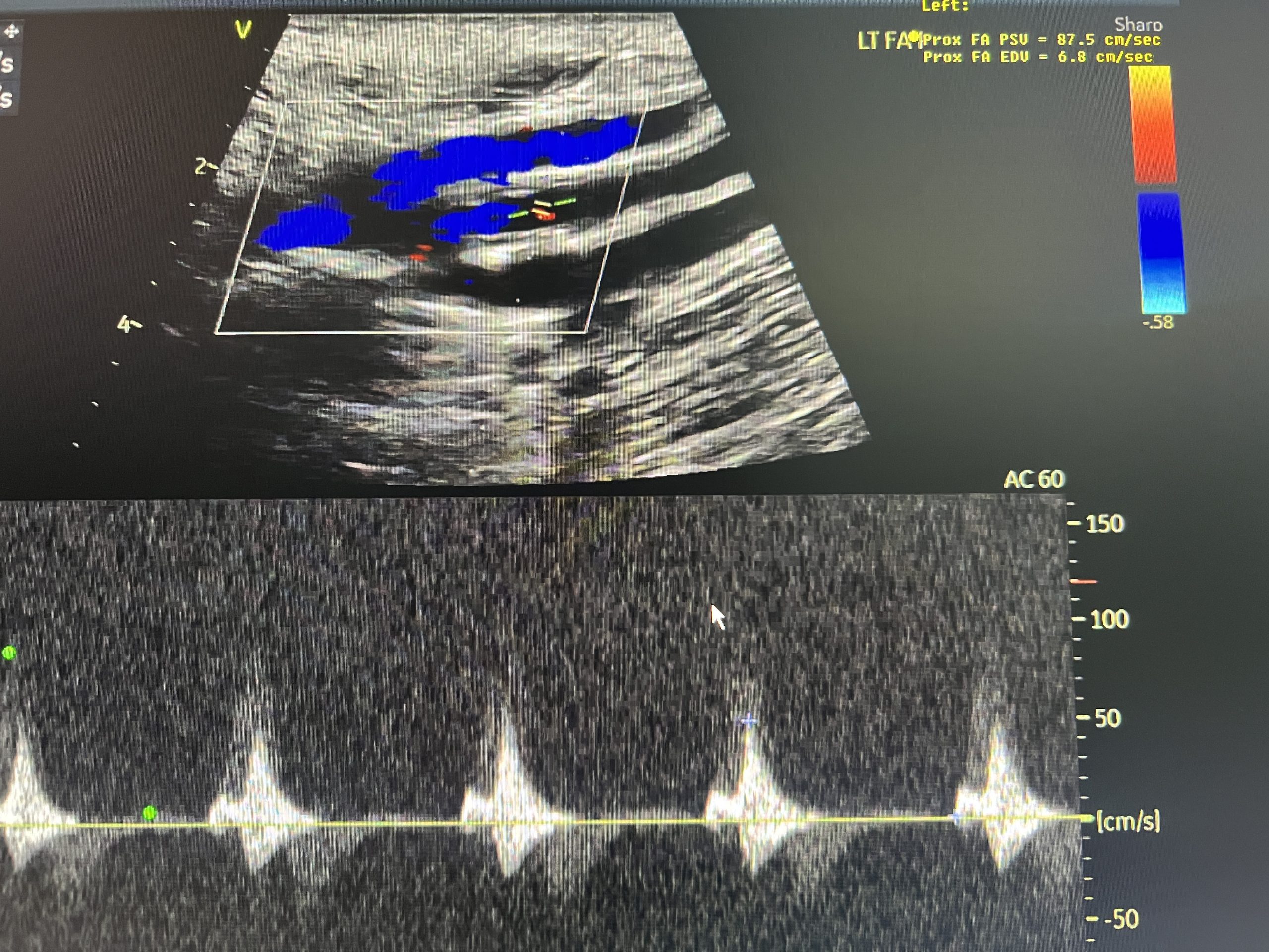 Recurrent Femoral Artery Occlusion with Failed Stent and Autogenous Bypass